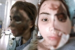 Cô gái Đà Nẵng bị chồng chưa cưới tạt axit gây rúng động: Đã ghép da lưng vào vùng mặt bị hủy hoại