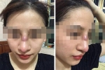 Cô gái 19 tuổi nhiễm trùng mũi sau khi làm đẹp ở spa