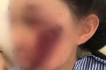 Áo chống nắng cuốn vào bánh xe khiến nữ sinh tổn thương mặt nghiêm trọng