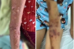 Bé 8 tuổi bị bỏng da nặng vì sứa: Cách sơ cứu nhiều người không biết