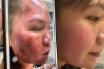 Sử dụng mỹ phẩm lột da trôi nổi, người phụ nữ bị bỏng nặng