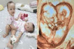 Lộ hình ảnh siêu âm của Trúc Nhi - Diệu Nhi trong bụng mẹ: 'Tụi con được sinh ra bởi lòng can trường của cha mẹ con'
