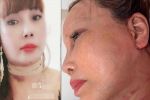 Cô dâu 63 tuổi ở Cao Bằng khoe vết sẹo chạy dọc phần tai sau 1 tháng phẫu thuật căng da mặt khiến nhiều người 'bủn rủn'