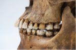 Phát hiện mới về đại dịch đầu tiên từ răng hóa thạch cổ xưa