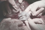 Em bé chào đời với 6 vòng dây rốn quấn cổ