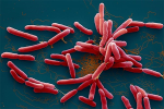 Nóng: Hà Nội phát hiện ca bệnh nhiễm vi khuẩn ăn thịt người