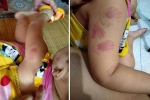Đi học buổi thứ 2, bé 21 tháng tuổi ở Thái Bình bị nhiều vết cắn tấy đỏ khắp người