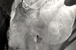 Người phụ nữ ở Hà Nội vỡ túi ngực silicon kèm khối u