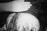 Bé gái mang khối u buồng trứng nặng 12 kg