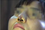 Người phụ nữ bị đứt lìa trụ mũi, chảy dịch và máu sau 12 ngày đi nâng mũi 'chui'