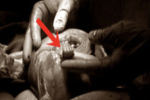 20 năm sau khoảnh khắc ấn tượng, thai nhi 21 tuần tuổi trong bức ảnh thò tay ra khỏi tử cung mẹ nắm chặt ngón tay bác sĩ giờ ra sao?
