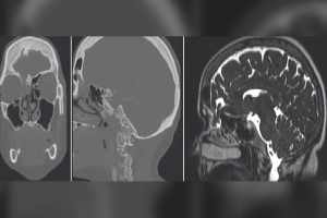 Bệnh nhân rỉ dịch não tủy vì xét nghiệm Covid-19 bằng tăm bông
