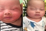 Bé trai 4 tháng nhiễm tụ cầu bị loét da mặt vì mẹ đắp thuốc lá theo dân gian