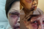 Người phụ nữ Mỹ gốc Việt bị đánh gãy xương mặt