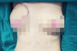 Tạo hình ngực cho bệnh nhân ung thư vú bằng da và mỡ vùng bụng
