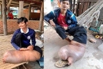 Bị muỗi đốt, chàng trai Campuchia phải sống với cái chân dị dạng suốt hơn 2 thập kỷ