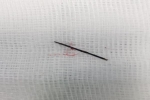 Phẫu thuật lấy chiếc kim khâu dài 17 mm ra khỏi cơ thể bé gái 3 tuổi