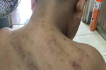 Nhiều vết bầm trên lưng, cổ bé trai 8 tuổi ở Phú Quốc nghi bị đánh