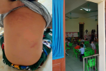 Vụ trẻ mầm non 15 tháng tuổi bị giáo viên bạo hành: Cô giáo nói dối cháu bị ngã