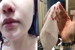 Cố chấp tắm gội lúc 12h khuya, cô gái hoảng loạn thấy máu mũi trào chảy, lo sợ tái diễn triệu chứng liệt nửa cơ mặt