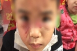 Hình ảnh cháu bé bị bố ruột bạo hành, đánh đập dã man tại Hà Nội khiến dân mạng phẫn nộ