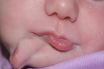 Bé gái sinh ra với chiếc miệng thứ hai ngay dưới cằm, bên trong có cả lưỡi vô cùng hiếm gặp thu hút sự chú ý lớn giờ ra sao?