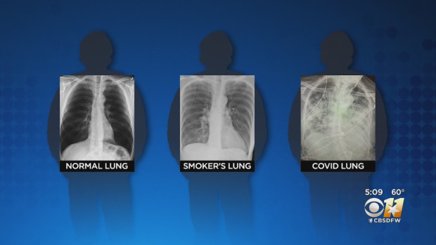 Hình ảnh phổi bình thường (trái), phổi của người hút thuốc (giữa) phổi của người bị nhiễm Covid-19 (phải).