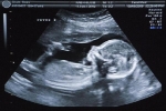 Kỳ lạ bé gái sơ sinh mang 'thai trong thai', vô cùng hiếm gặp