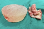 Kinh hoàng: Nữ bệnh nhân bị spa bỏ quên miếng gạc trong ngực suốt 1 tháng khiến ngực lở loét chảy dịch khủng khiếp