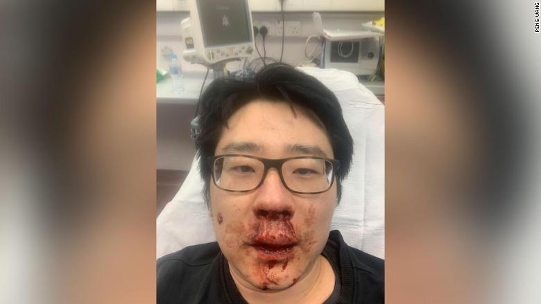 Peng Wang bị tấn công bên ngoài nhà riêng ở Southampton, Anh. Ảnh: CNN.
