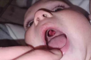 Mẹ hoảng hồn phát hiện chiếc lỗ to tướng trong miệng con liền bế đứa trẻ đi cấp cứu để rồi ôm nỗi xấu hổ sau khi y tá kiểm tra