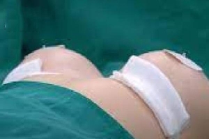 Vụ cô gái 30 tuổi tử vong sau khi nâng ngực ở phòng khám tư: Diễn biến mới nhất