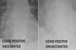Bác sĩ Mỹ tiết lộ 1 điểm khác biệt đầy kinh ngạc khi so sánh ảnh chụp phổi bệnh nhân COVID-19 đã tiêm và chưa tiêm vaccine
