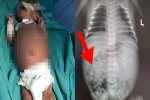 Kết quả siêu âm thai bất thường, bác sĩ đưa đứa trẻ đi chụp X-quang ngay khi vừa chào đời và phát hiện điều hiếm thấy