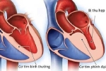 Viêm cơ tim sau tiêm vaccine COVID-19 có đáng ngại?
