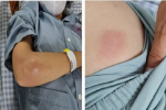 Một phụ nữ ở Tuyên Quang được phát hiện mắc bệnh Whitmore