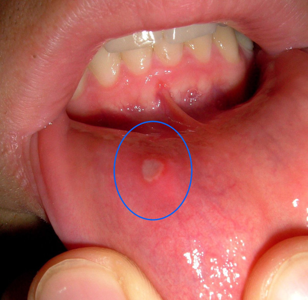 Đây là hiện tượng xuất hiện ở miệng mà 90% người mắc phải có thể là dấu hiệu cảnh báo ung thư nhưng không ai để ý - Ảnh 1.