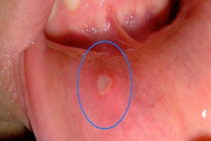 Đây là hiện tượng xuất hiện ở miệng mà 90% người mắc phải có thể là dấu hiệu cảnh báo ung thư nhưng không ai để ý