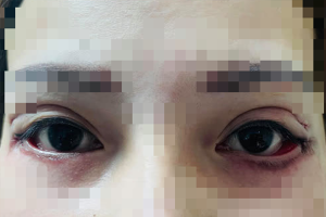 Cô gái trẻ suýt bị mù sau khi... cắt mí mắt