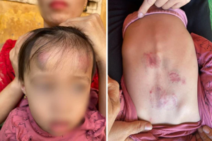 Vụ bé gái 2 tuổi bị bạn học đánh dã man trong trường mầm non: Cô giáo đi lấy cơm nên không hay biết, gia đình yêu cầu hướng xử lý cụ thể