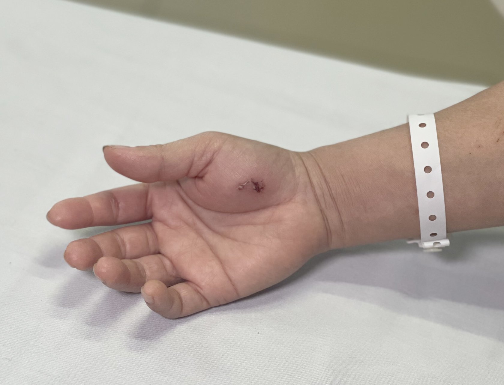  Hình ảnh vết cắn của con cu li trên tay bệnh nhân.
