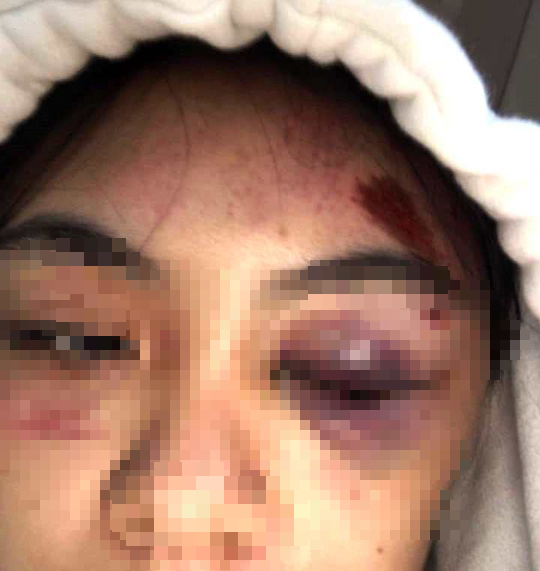 Nữ sinh bị đánh hội đồng dã man phải nhập viện cấp cứu: Xử dằn mặt vì ghen tuông! - Ảnh 3.