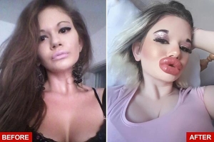Người phụ nữ có 'đôi môi lớn nhất thế giới' chuẩn bị bơm môi lần thứ 27 vì muốn giống búp bê