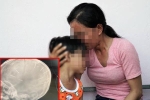 Hà Nội: Bé gái 3 tuổi nhập viện với 9 chiếc đinh găm sâu vào đầu, nghi bị bạo hành