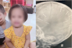 Tình trạng bé gái ở Hà Nội bị nhiều đinh găm vào đầu vẫn rất nặng