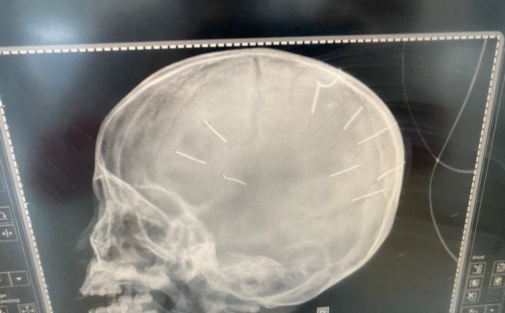 Hình chụp X-quang của bé A.