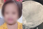 Hà Nội yêu cầu công an báo cáo vụ bé 3 tuổi bị đóng đinh vào đầu