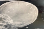 Bé 3 tuổi ở Hà Nội bị ghim đinh vào đầu vẫn chưa thể phẫu thuật