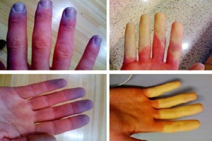 Cảnh giác với căn bệnh mùa lạnh khiến bàn tay 'biến sắc', nặng có thể hoại tử