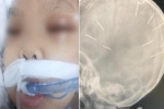 Bé gái 4 tuổi bị găm 9 đinh vào đầu: Gia đình thông báo tín hiệu sức khỏe đáng mừng hơn